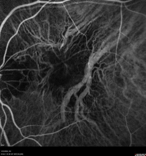 wet AMD with classic extrafoveal macular neovascularization in the good eye
89 year old man with longstanding vision loss in the left eye presented with one month of mild vision loss in the right eye.  Vision was 20/32.  This eye responded to vabysmo therapy.
