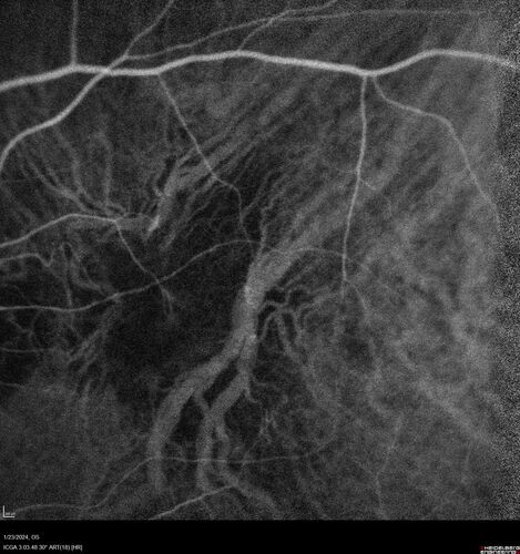 wet AMD with classic extrafoveal macular neovascularization in the good eye
89 year old man with longstanding vision loss in the left eye presented with one month of mild vision loss in the right eye.  Vision was 20/32.  This eye responded to vabysmo therapy.
