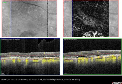wet AMD with classic extrafoveal macular neovascularization in the good eye
89 year old man with longstanding vision loss in the left eye presented with one month of mild vision loss in the right eye.  Vision was 20/32.  This eye responded to vabysmo therapy.
