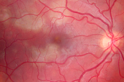 Acute Posterior Multifocal Placoid Pigment Epitheliopathy - APMPPE - Fundus Photo - Color
 25-year-old man with one and half weeks ago he woke up with night chills.   Also around that time his joints started hurting him.  He also has headaches, although the headache at this point is not severe.  His vision has been changing for about the last week and a half.  He sees some spots in his vision and they are blurred spots.  They are not in the central vision.  
VISUAL ACUITY:  OD 20/32,  OS 20/32
