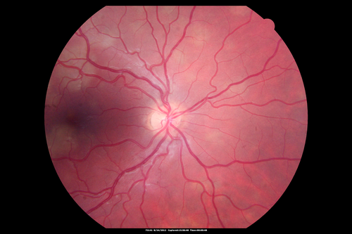 Acute Posterior Multifocal Placoid Pigment Epitheliopathy - APMPPE - Fundus Photo - Color
 25-year-old man with one and half weeks ago he woke up with night chills.   Also around that time his joints started hurting him.  He also has headaches, although the headache at this point is not severe.  His vision has been changing for about the last week and a half.  He sees some spots in his vision and they are blurred spots.  They are not in the central vision.  
VISUAL ACUITY:  OD 20/32,  OS 20/32
