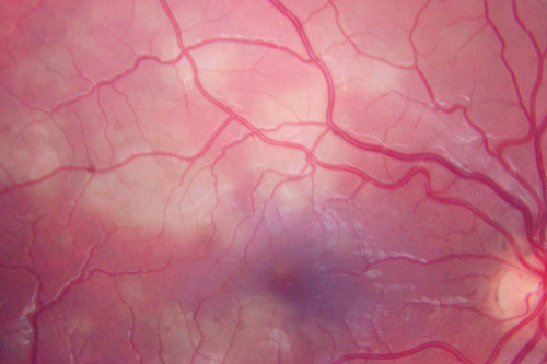 Acute Posterior Multifocal Placoid Pigment Epitheliopathy - APMPPE - Fundus Photo - Color
 25-year-old man with one and half weeks ago he woke up with night chills.   Also around that time his joints started hurting him.  He also has headaches, although the headache at this point is not severe.  His vision has been changing for about the last week and a half.  He sees some spots in his vision and they are blurred spots.  They are not in the central vision.  
VISUAL ACUITY:  OD 20/32,  OS 20/32
