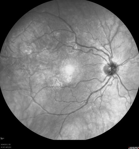 Acute Posterior Multifocal Placoid Pigment Epitheliopathy - APMPPE - InfraRed Photo
 25-year-old man with one and half weeks ago he woke up with night chills.   Also around that time his joints started hurting him.  He also has headaches, although the headache at this point is not severe.  His vision has been changing for about the last week and a half.  He sees some spots in his vision and they are blurred spots.  They are not in the central vision.  
VISUAL ACUITY:  OD 20/32,  OS 20/32
