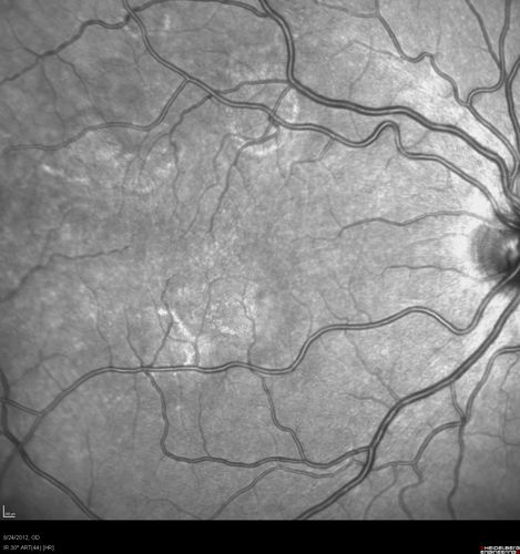 Acute Posterior Multifocal Placoid Pigment Epitheliopathy - APMPPE - InfraRed Photo
 25-year-old man with one and half weeks ago he woke up with night chills.   Also around that time his joints started hurting him.  He also has headaches, although the headache at this point is not severe.  His vision has been changing for about the last week and a half.  He sees some spots in his vision and they are blurred spots.  They are not in the central vision.  
VISUAL ACUITY:  OD 20/32,  OS 20/32
