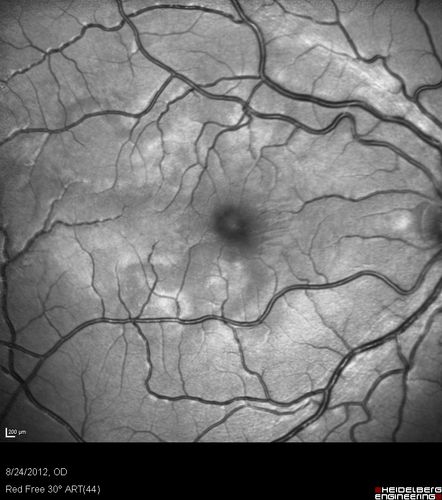 Acute Posterior Multifocal Placoid Pigment Epitheliopathy - APMPPE - Red Free Photo
 25-year-old man with one and half weeks ago he woke up with night chills.   Also around that time his joints started hurting him.  He also has headaches, although the headache at this point is not severe.  His vision has been changing for about the last week and a half.  He sees some spots in his vision and they are blurred spots.  They are not in the central vision.  
VISUAL ACUITY:  OD 20/32,  OS 20/32
