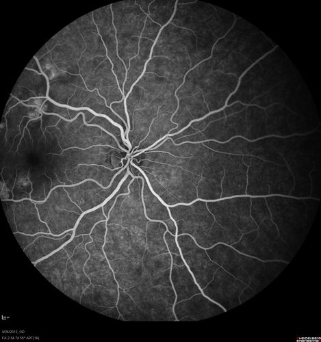 Acute Posterior Multifocal Placoid Pigment Epitheliopathy - APMPPE - Fluorescein Angiogram
 25-year-old man with one and half weeks ago he woke up with night chills.   Also around that time his joints started hurting him.  He also has headaches, although the headache at this point is not severe.  His vision has been changing for about the last week and a half.  He sees some spots in his vision and they are blurred spots.  They are not in the central vision.  
VISUAL ACUITY:  OD 20/32,  OS 20/32
