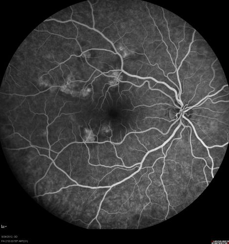 Acute Posterior Multifocal Placoid Pigment Epitheliopathy - APMPPE - Fluorescein Angiogram
 25-year-old man with one and half weeks ago he woke up with night chills.   Also around that time his joints started hurting him.  He also has headaches, although the headache at this point is not severe.  His vision has been changing for about the last week and a half.  He sees some spots in his vision and they are blurred spots.  They are not in the central vision.  
VISUAL ACUITY:  OD 20/32,  OS 20/32
