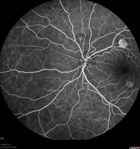 Acute Posterior Multifocal Placoid Pigment Epitheliopathy - APMPPE - Fluorescein Angiogram
 25-year-old man with one and half weeks ago he woke up with night chills.   Also around that time his joints started hurting him.  He also has headaches, although the headache at this point is not severe.  His vision has been changing for about the last week and a half.  He sees some spots in his vision and they are blurred spots.  They are not in the central vision.  
VISUAL ACUITY:  OD 20/32,  OS 20/32
