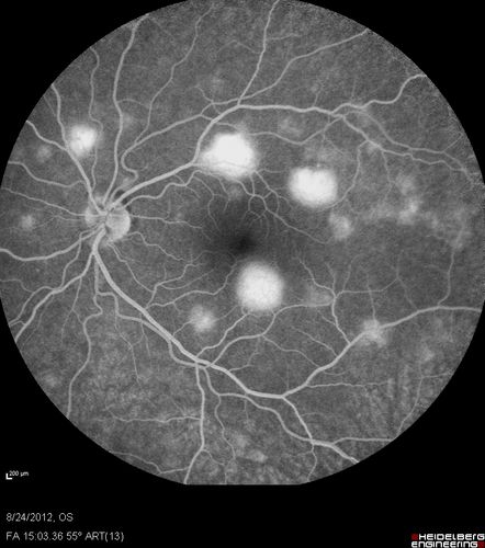 Acute Posterior Multifocal Placoid Pigment Epitheliopathy - APMPPE - Fluorescein Angiogram
 25-year-old man with one and half weeks ago he woke up with night chills.   Also around that time his joints started hurting him.  He also has headaches, although the headache at this point is not severe.  His vision has been changing for about the last week and a half.  He sees some spots in his vision and they are blurred spots.  They are not in the central vision.  
VISUAL ACUITY:  OD 20/32,  OS 20/32
