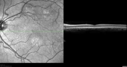 Acute Posterior Multifocal Placoid Pigment Epitheliopathy - APMPPE  - SD-OCT 
 25-year-old man with one and half weeks ago he woke up with night chills.   Also around that time his joints started hurting him.  He also has headaches, although the headache at this point is not severe.  His vision has been changing for about the last week and a half.  He sees some spots in his vision and they are blurred spots.  They are not in the central vision.  
VISUAL ACUITY:  OD 20/32,  OS 20/32
