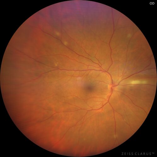 Acute retinal necrosis
67 year old female Hazy vision in the right eye for 5 days.
Medical Hx: TYPE 2 DIAB.. Hypercholesterolemia. 
Surgical Hx: COLECTOMY. 
Systemic Meds: CRESTOR 10 MG QD. METFORMIN 500 MG QD. PROLIA Q 6 MOS. SULFA 800 MG/ TRIMETHOPRIM 160 MG TID. VALCYCLOVIR 1 GM TID. PROBIOTIC QD. CENTRUM 50+ QD. ALLERGY MED QD
VA 20/40, 20/20
IOP 19, 12
SLE: Trace AC cell OD and moderate vitreous cell OD
