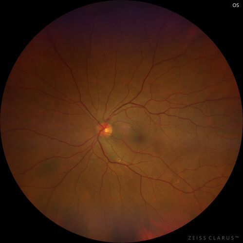 Acute retinal necrosis
67 year old female Hazy vision in the right eye for 5 days.
Medical Hx: TYPE 2 DIAB.. Hypercholesterolemia. 
Surgical Hx: COLECTOMY. 
Systemic Meds: CRESTOR 10 MG QD. METFORMIN 500 MG QD. PROLIA Q 6 MOS. SULFA 800 MG/ TRIMETHOPRIM 160 MG TID. VALCYCLOVIR 1 GM TID. PROBIOTIC QD. CENTRUM 50+ QD. ALLERGY MED QD
VA 20/40, 20/20
IOP 19, 12
SLE: Trace AC cell OD and moderate vitreous cell OD
