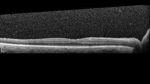 Acute retinal necrosis
67 year old female Hazy vision in the right eye for 5 days.
Medical Hx: TYPE 2 DIAB.. Hypercholesterolemia. 
Surgical Hx: COLECTOMY. 
Systemic Meds: CRESTOR 10 MG QD. METFORMIN 500 MG QD. PROLIA Q 6 MOS. SULFA 800 MG/ TRIMETHOPRIM 160 MG TID. VALCYCLOVIR 1 GM TID. PROBIOTIC QD. CENTRUM 50+ QD. ALLERGY MED QD
VA 20/40, 20/20
IOP 19, 12
SLE: Trace AC cell OD and moderate vitreous cell OD
