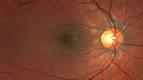 Acute Retinal Pigment Epitheliitis (Krills disease)
15 year old with sudden central vision loss in one eye.  The vision loss persisted though for at least 6 months (which may be a laser injury)
