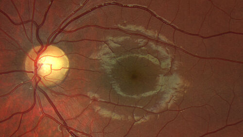 Acute Retinal Pigment Epitheliitis (Krills disease)
15 year old with sudden central vision loss in one eye.  The vision loss persisted though for at least 6 months (which may be a laser injury)
