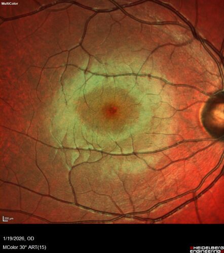 Acute Retinal Pigment Epitheliitis (Krills disease)
15 year old with sudden central vision loss in one eye.  The vision loss persisted though for at least 6 months (which may be a laser injury)
