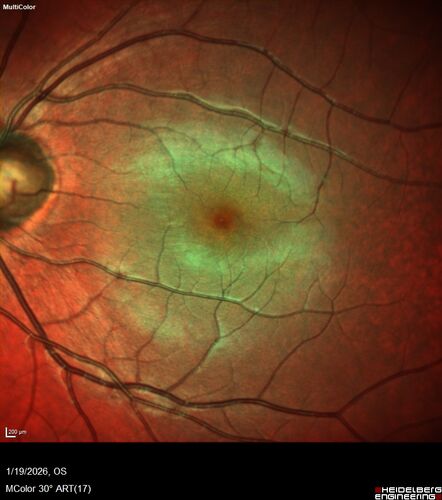 Acute Retinal Pigment Epitheliitis (Krills disease)
15 year old with sudden central vision loss in one eye.  The vision loss persisted though for at least 6 months (which may be a laser injury)
