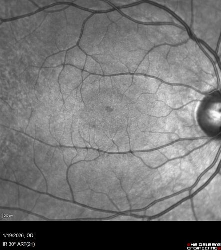 Acute Retinal Pigment Epitheliitis (Krills disease)
15 year old with sudden central vision loss in one eye.  The vision loss persisted though for at least 6 months (which may be a laser injury)
