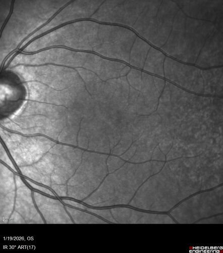 Acute Retinal Pigment Epitheliitis (Krills disease)
15 year old with sudden central vision loss in one eye.  The vision loss persisted though for at least 6 months (which may be a laser injury)
