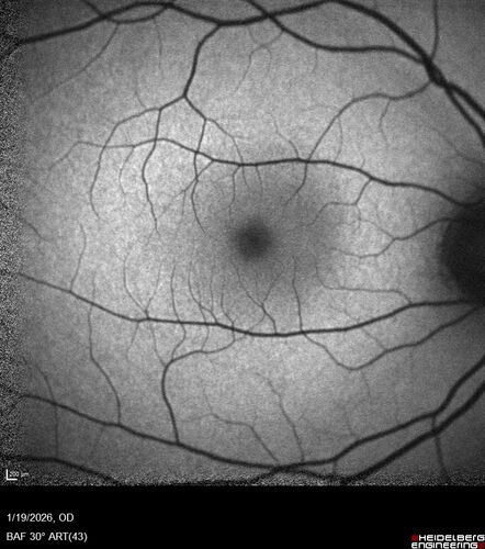 Acute Retinal Pigment Epitheliitis (Krills disease)
15 year old with sudden central vision loss in one eye.  The vision loss persisted though for at least 6 months (which may be a laser injury)
