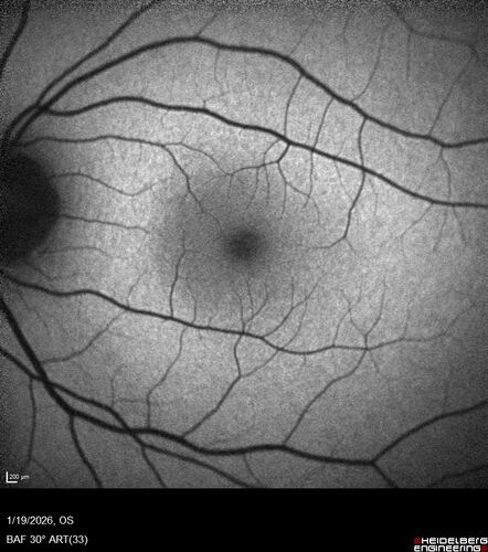 Acute Retinal Pigment Epitheliitis (Krills disease)
15 year old with sudden central vision loss in one eye.  The vision loss persisted though for at least 6 months (which may be a laser injury)
