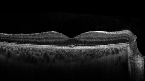Acute Retinal Pigment Epitheliitis (Krills disease)
15 year old with sudden central vision loss in one eye.  The vision loss persisted though for at least 6 months (which may be a laser injury)
