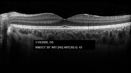 Acute Retinal Pigment Epitheliitis (Krills disease)
15 year old with sudden central vision loss in one eye.  The vision loss persisted though for at least 6 months (which may be a laser injury)
