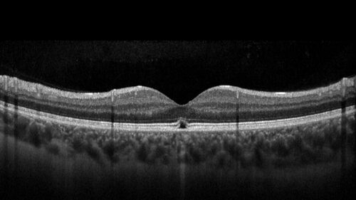 Acute Retinal Pigment Epitheliitis (Krills disease)
15 year old with sudden central vision loss in one eye.  The vision loss persisted though for at least 6 months (which may be a laser injury)

