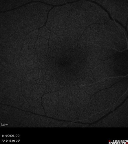 Acute Retinal Pigment Epitheliitis (Krills disease)
15 year old with sudden central vision loss in one eye.  The vision loss persisted though for at least 6 months (which may be a laser injury)
