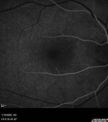 Acute Retinal Pigment Epitheliitis (Krills disease)
15 year old with sudden central vision loss in one eye.  The vision loss persisted though for at least 6 months (which may be a laser injury)
