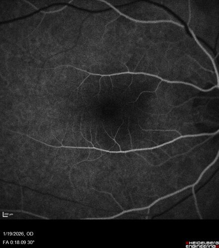 Acute Retinal Pigment Epitheliitis (Krills disease)
15 year old with sudden central vision loss in one eye.  The vision loss persisted though for at least 6 months (which may be a laser injury)
