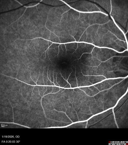 Acute Retinal Pigment Epitheliitis (Krills disease)
15 year old with sudden central vision loss in one eye.  The vision loss persisted though for at least 6 months (which may be a laser injury)
