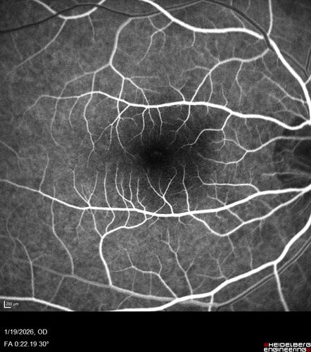 Acute Retinal Pigment Epitheliitis (Krills disease)
15 year old with sudden central vision loss in one eye.  The vision loss persisted though for at least 6 months (which may be a laser injury)
