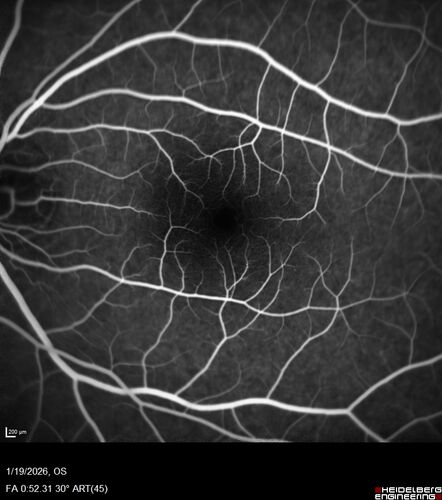 Acute Retinal Pigment Epitheliitis (Krills disease)
15 year old with sudden central vision loss in one eye.  The vision loss persisted though for at least 6 months (which may be a laser injury)
