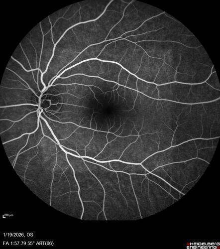 Acute Retinal Pigment Epitheliitis (Krills disease)
15 year old with sudden central vision loss in one eye.  The vision loss persisted though for at least 6 months (which may be a laser injury)
