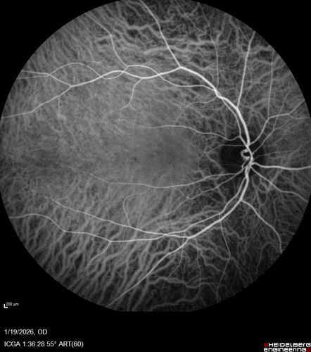 Acute Retinal Pigment Epitheliitis (Krills disease)
15 year old with sudden central vision loss in one eye.  The vision loss persisted though for at least 6 months (which may be a laser injury)
