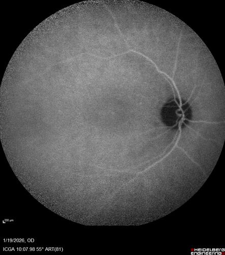 Acute Retinal Pigment Epitheliitis (Krills disease)
15 year old with sudden central vision loss in one eye.  The vision loss persisted though for at least 6 months (which may be a laser injury)
