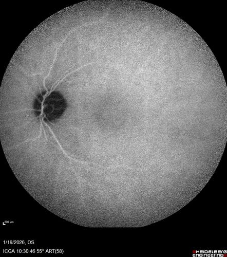 Acute Retinal Pigment Epitheliitis (Krills disease)
15 year old with sudden central vision loss in one eye.  The vision loss persisted though for at least 6 months (which may be a laser injury)
