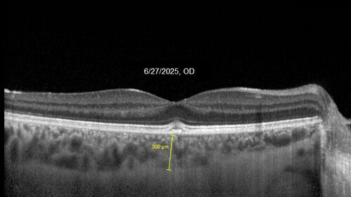 Acute Retinal Pigment Epitheliitis (Krills disease)
15 year old with sudden central vision loss in one eye.  The vision loss persisted though for at least 6 months (which may be a laser injury)
