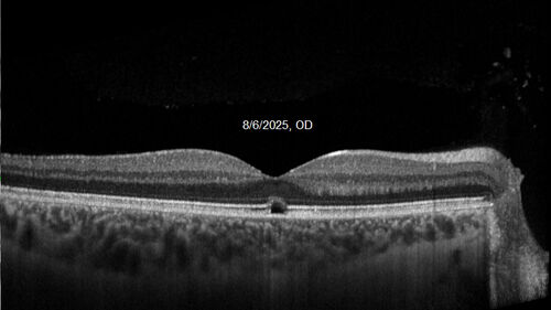 Acute Retinal Pigment Epitheliitis (Krills disease)
15 year old with sudden central vision loss in one eye.  The vision loss persisted though for at least 6 months (which may be a laser injury)
