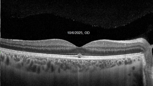 Acute Retinal Pigment Epitheliitis (Krills disease)
15 year old with sudden central vision loss in one eye.  The vision loss persisted though for at least 6 months (which may be a laser injury)
