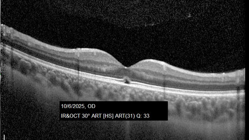 Acute Retinal Pigment Epitheliitis (Krills disease)
15 year old with sudden central vision loss in one eye.  The vision loss persisted though for at least 6 months (which may be a laser injury)
