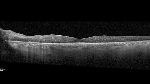 AZOOR - Inactive
Sudden vision loss in the left eye 3 years ago.  Labs for syphilis, sarcoid and TB all negative.  VA 20/32 OD, 20/80 OS
