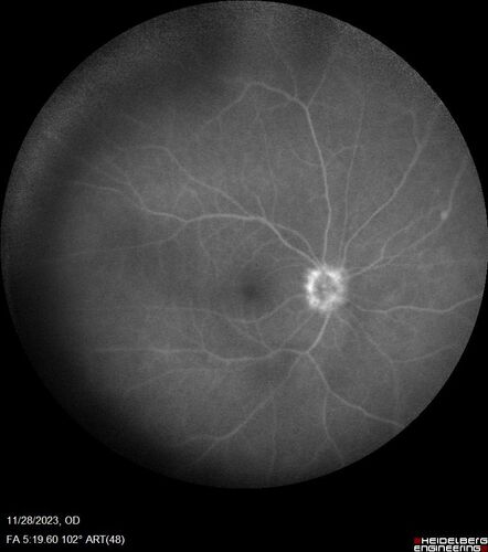 AZOOR - Inactive
Sudden vision loss in the left eye 3 years ago.  Labs for syphilis, sarcoid and TB all negative.  VA 20/32 OD, 20/80 OS
