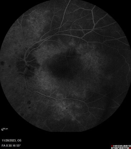AZOOR - Inactive
Sudden vision loss in the left eye 3 years ago.  Labs for syphilis, sarcoid and TB all negative.  VA 20/32 OD, 20/80 OS
