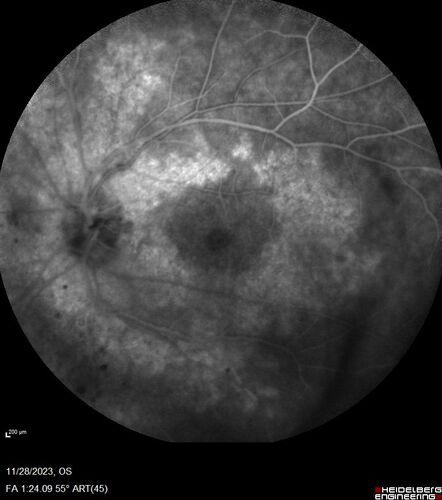 AZOOR - Inactive
Sudden vision loss in the left eye 3 years ago.  Labs for syphilis, sarcoid and TB all negative.  VA 20/32 OD, 20/80 OS
