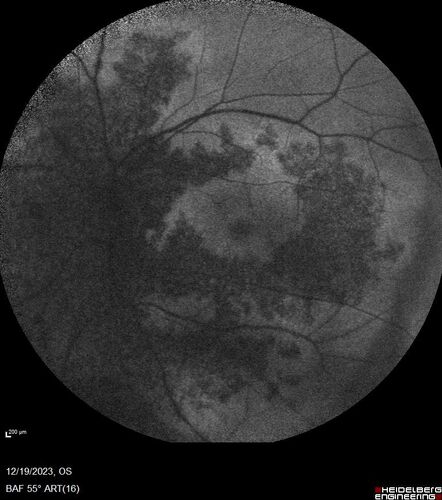 AZOOR - Inactive
Sudden vision loss in the left eye 3 years ago.  Labs for syphilis, sarcoid and TB all negative.  VA 20/32 OD, 20/80 OS

