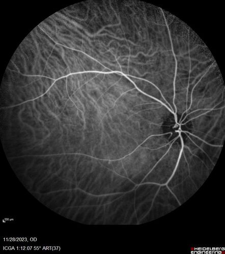 AZOOR - Inactive
Sudden vision loss in the left eye 3 years ago.  Labs for syphilis, sarcoid and TB all negative.  VA 20/32 OD, 20/80 OS
