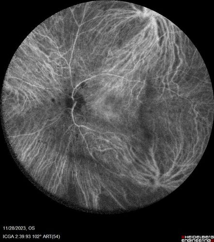 AZOOR - Inactive
Sudden vision loss in the left eye 3 years ago.  Labs for syphilis, sarcoid and TB all negative.  VA 20/32 OD, 20/80 OS
