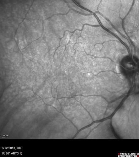 Macular Hole Left Eye - progression from VMT - Stage II macular hole - Spontaneously Closed Macular Hole
